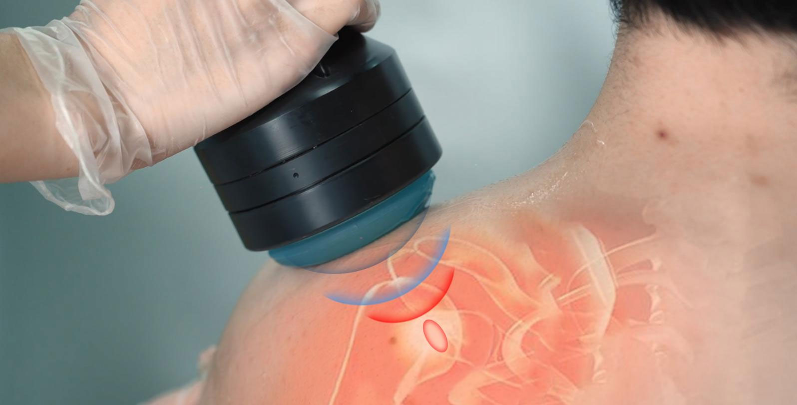 Shockwave-Therapy.1.jpg